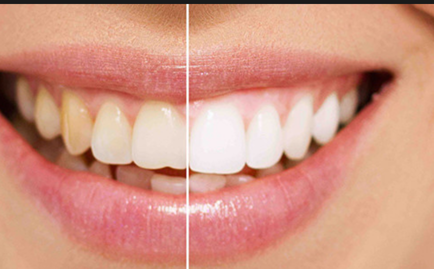 Tipi Macchie sui Denti